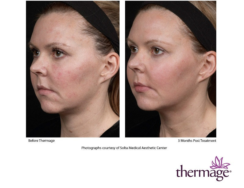 Before And After Face By Thermage™