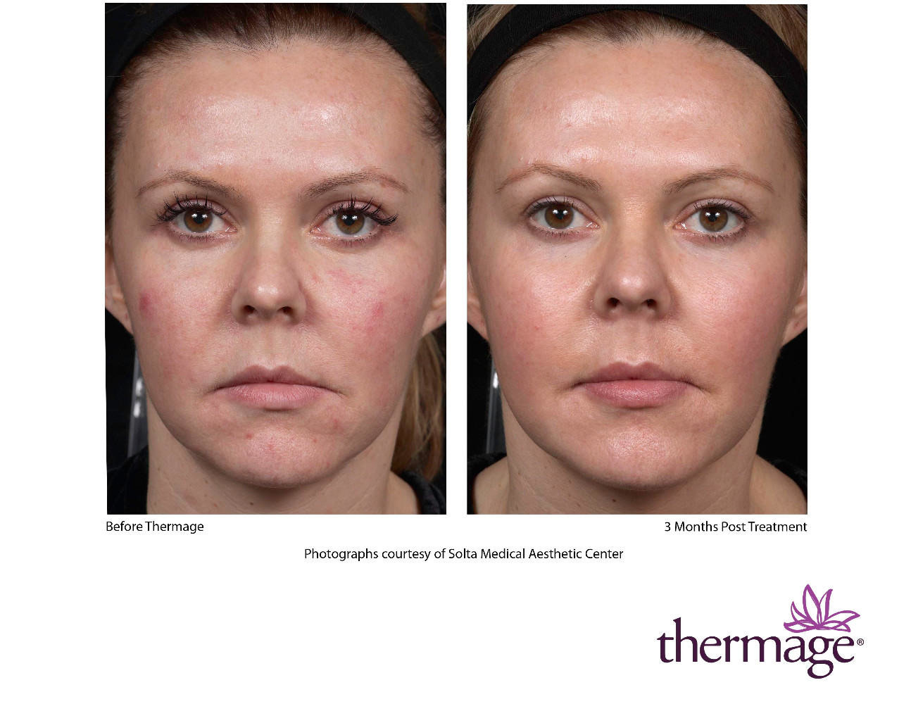 Before And After Face By Thermage™