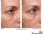 Before and after Thermage eyes 