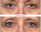 Before and after Thermage eyes 