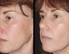 Before treatment and immediately post treatment